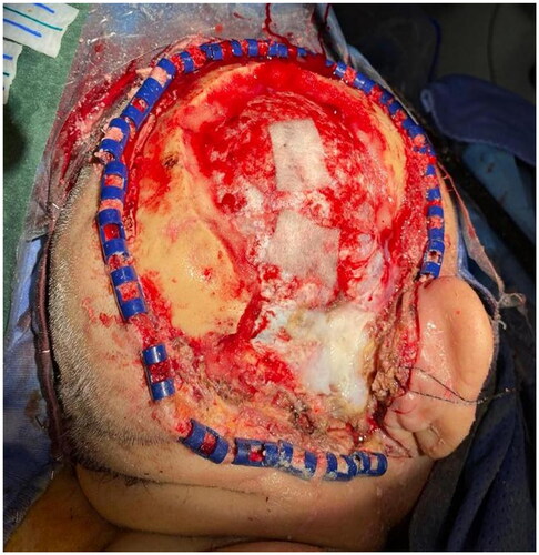 Figure 2. Intraoperative view after the neurosurgical removal of the lesion.