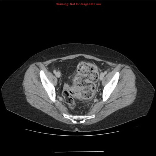 Fig. 1 Image depicting large fecal load, sigmoid wall thickening and extensive peri-colonic infiltrative change.