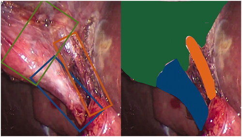 Figure 2. Use of bounding boxes (left) may result in overlapping identification of structures versus semantic segmentation (right). Consideration should be given to which approach more faithfully reflects the clinical phenomenon of interest. Green denotes gallbladder, blue denotes cystic duct, orange denotes cystic artery.