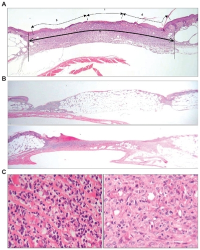Figure 1 Histological assessments/scoring methods of wound healing in db/db mice. A single, standardized full-thickness wound (7.5 mm × 7.5 mm) was created in the flank skin of each experimental db/db mouse. (A) Wound width measurement method. Wound width was measured as the distance between normal dermal tissues (wound curvature was taken into account) where “a” stands for margin to margin separation (wound width), “b + d” stands for neo-epithelial coverage, and “c” stands for nonepithelialized tissue (open wound). Three wound-width measurements (from three replicate sections) were taken and mean wound width was calculated for each wound. (B) Granular tissue formation: upper panel represents 0% to 20% of wound void filled with granulation tissue; lower panel represents 80% to 100% of wound void filled with granulation tissue. (C) Cell type or cellularity scoring system. The left panel represents a highly inflammatory condition and the right panel shows a highly proliferative condition.