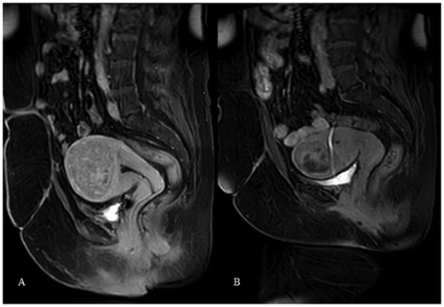 Figure 3. (A) Presents contrast-enhanced MRI of the fibroid prior to UFE. (B) present the same fibroid after UFE with incomplete fibroid infarction (<90%) and with residual contrast enhancement over 10%. The central part of the fibroid is with residual contrast enhancement. Category 3.