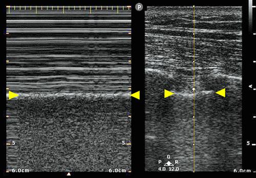 Figure 2 M-mode (left image) and B-mode (right image). On the right image, the M-mode shooting line is in the middle of the picture (circle and yellow line). Above the pleural line (yellow arrows), there are several horizontal lines. A sandy pattern below the pleural line is known as the seashore sign, which is generated by lung sliding. This confirms that the lung is ventilated.