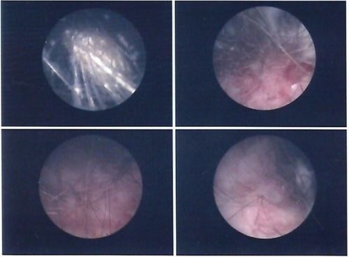 Figure 2 Cystoscopy findings.
