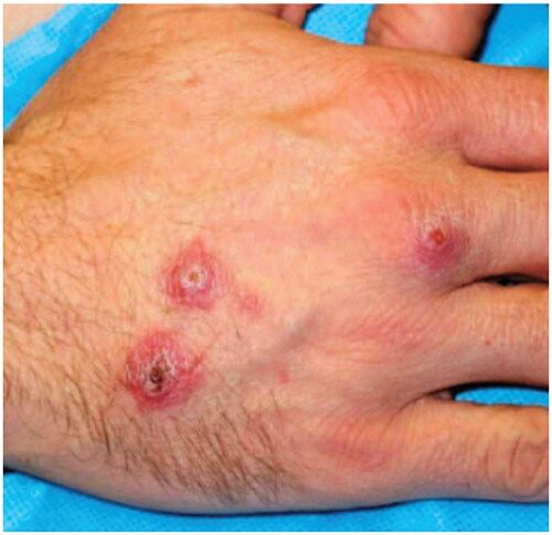 Figure 3. Cutaneous leishmaniasis. Central domed, eroded, and crusted erythematous nodules on the right dorsal hand of a soldier returning from Iraq deployment. This case has been previously reported. Reprinted with permission from Pehoushek et al. [Citation51], with permission from Elsevier.