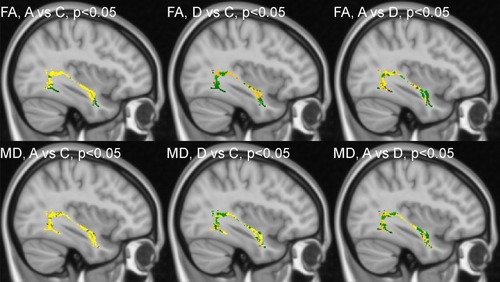 Figure 1 Tract-Based spatial statistics for the left inferior longitudinal fasciculus. Voxels without differences between the two groups are in green. Voxels with the most significant differences between the two groups are coded using a red-to-yellow color map.