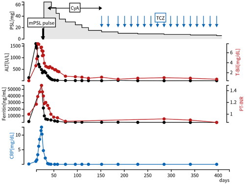 Figure 2. Clinical course of a present case. T-Bil, ALT, ferritin, PT-INR, and CRP improved after initiation of high-dose PSL and CyA, and his disease status remained stable without relapse for half a year after we switched CyA to TCZ. Abbreviations: CyA: cyclosporine; mPSL: methylprednisolone; PSL: prednisolone; TCZ: tocilizumab.