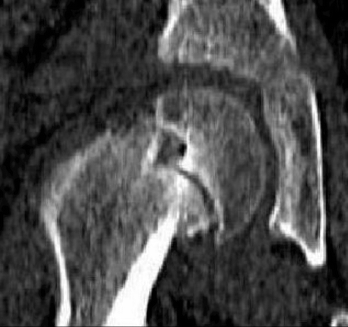 Figure 4. AP CT scanogram of the right hip of a 13-year-old boy, showing a well-developed epiphyseal tubercle that is clearly displacing out of the metaphyseal socket as an acute-on-chronic slip develops.