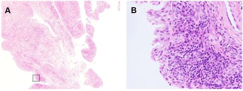 Figure 4 Section of the shoulder joint synovium. (A) shows hematoxylin and eosin (H&E) staining at low magnification (× 40). (B) shows H&E staining at high magnification (× 400). The synovium proliferated in the form of villi. There was infiltration by inflammatory cells, which included plasma cells, with blood vessel proliferation. Findings were consistent with nonspecific synovitis with no bacterial phagocytosis. There were no tumor cells.