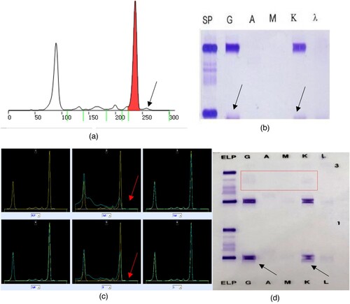 Figure 2. Results of the second serum protein electrophoresis, immunofixation electrophoresis, immunophenotyping and the Hydrashift 2/4 Daratumumab Assay (May 27, 2021). (A) (SPE) shows that there was one M proteins in the SPE, with an extra band (the arrow points). (B) (SIFE) shows that the immunotyping was IgG κ, with an extra band (the arrow points). (C) (immunophenotyping) also shows that the immunotyping was IgG κ, with an extra band (the arrow points). (D) (Hydrashift 2/4 Daratumumab Assay) shows the extra band was removed from the point of the arrow to the red box.