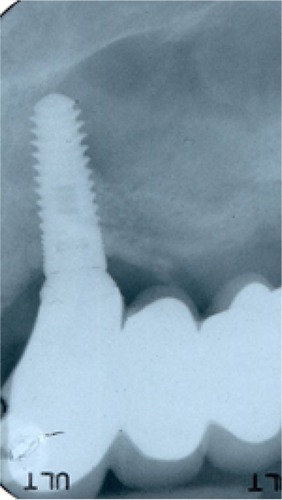 Figure 2 A larger and longer implant was placed to support the long-span fixed partial denture.