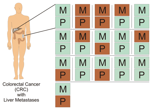 Figure 4. Prognostic signature of immune cell infiltration in primary colorectal carcinoma lesions and hepatic colorectal carcinoma metastases. CD3+,CD8+ and granzyme B+ cell densities were translated into a favorable (good) or unfavorable (bad) prognostic signature as described by Galon et al. and Halama et al. Each of presented doublets (P, primary tumor; M, metastasis) represents the samples of a single patient. Green, favorable signature; Red, unfavorable signature.