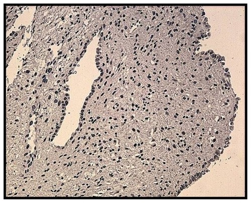 Figure 1 Atrophic endometrium in a patient who had been using Mirena® for 5 years.