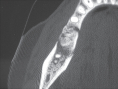 Figure 8 Abscessual complication of necrotic bone lesion in patient treated with Zometa® for 11 months (61 years old, male, prostatic cancer).