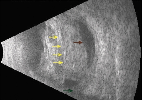 Figure 1 B-scan ultrasound image of a patient with extensive suprachoroidal hemorrhage secondary to tube shunt procedure treated with suprachoroidal r-tPA the day before surgery. Notice the dome shaped appearance and central apposition of detached choroid (yellow arrows). Shadow of glaucoma tube shunt (brown arrow). Optic nerve shadow (green arrow).