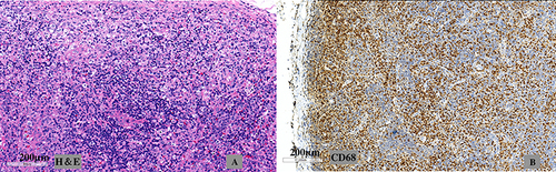 Figure 1 (A) Cervical lymph node biopsy section: areas of lymphocytic proliferation, apoptotic necrosis, and histiocytes infiltration. (Hematoxylin and Eosin staining). (B) CD68(+) histiocytes visualized on immunohistochemical staining.