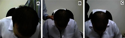 Figure 7 Representative photographs of a subject with frontal alopecia treated with placebo. (A) Baseline, (B) at week 8 (slight decrease in hair growth), and (C) week 16 (moderate decrease in hair growth).