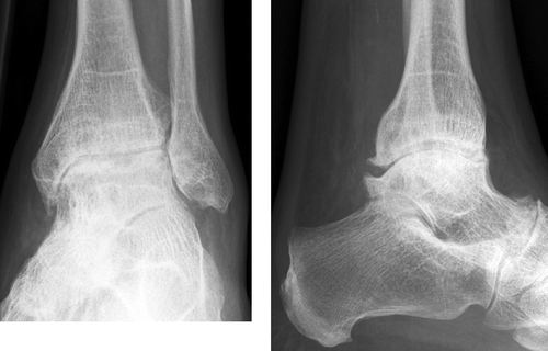 Figure 1. Severe degenerative changes.