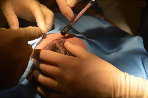 Figure 4 Scalp area prepared for injection.