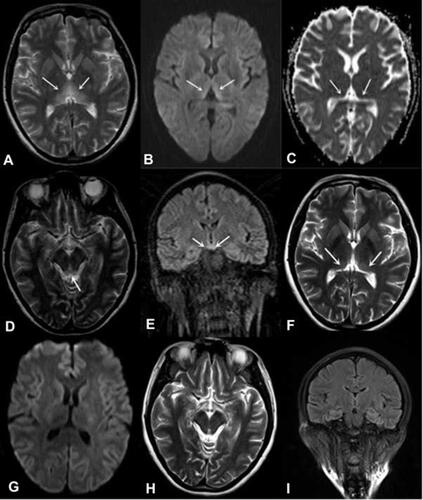 Figure 2 A 44-year-old woman (Patient 5) had a history of surgery and fasting for her gastric stromal tumor and presented with the classic triad. MRI showed hyperintensity of the symmetric medial thalamus (A), tectal plate (D) and mammillary bodies (E). DWI showed hyperintensity of the symmetric medial thalamus (B), while ADC showed hypointensity (C). Repeated MRI scans 8 months after presentation (F–I). The hyperintensity of the symmetric medial thalamus had decreased on T2WI (F), while intensity was normal on DWI (G). The intensity of the tectal plate observed by T2WI (H) and the mammillary bodies observed by FLAIR (I) were normal.Notes: The white arrows in panel A represent the hyperintensive symmetric medial thalamus on T2WI. The white arrows in panel B represent the hyperintensive symmetric medial thalamus on DWI. The white arrows in panel C represent the hypointensive symmetric medial thalamus on ADC. The white arrow in panel D represents the hyperintensive tectal plate of midbrain  on T2WI. The white arrows in panel E represent the hyperintensive mammillary bodies on FLAIR. The white arrows in panel F represent the hyperintensive symmetric medial thalamus on T2WI 8 months after presentation.Abbreviations: ADC, apparent diffusion coefficient; DWI, diffusion-weighted imaging; FLAIR, fluid-attenuated inversion recovery; MRI, magnetic resonance imaging; T2WI, T2-weighted imaging.