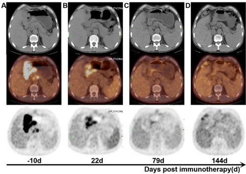 Figure 3 Treatment effect images of patients before and after immunotherapy. (A) PET/CT images of the whole body before immunotherapy (−10d). (B) A follow-up PET/CT images after two injections of Nivolumab 200 mg (22 d). (C) A follow-up PET/CT images underwent six doses of Nivolumab (79 d). (D) A follow-up PET/CT images after combination therapy (144 d). We stipulated the starting date for immunotherapy at day 0.