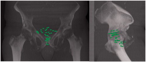 Figure 2. Digital reconstructed radiograph showing the spatial distribution of all local relapses obtained after deformable registration of the 18F-FCH PET imaging sets into the scan of one reference patient using the ATLAS option of the MIMVista® 6.5.2 Software.