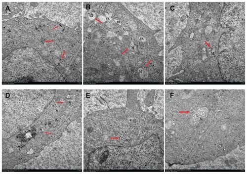 Figure 8 Transmission electron images of HeLa cells treated with a solution of CONPs (30 μg/mL) for 4 hours. The arrows indicate the accumulation of the CONPs. (A) The CONPs entered a mitochondrion and broke its outer membrane. CONPs existed in vesicles and in the cytoplasm. (B) The endoplasmic reticulum swelled visibly. A structure similar to an autophagy body phagocytized a group of CONPs. (C) The vesicles containing the CONPs appeared to target the outer membrane of the mitochondrion, and the shape of the mitochondrion had changed. (D) CONPs localized in small vesicles and entered or were entering the mitochondrion. (E and F) CONPs broke the membrane of the mitochondrion and caused structural changes.Abbreviations: CONPs, cuprous oxide nanoparticles; M, mitochondrion; ER, endoplasmic reticulum.