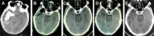 Figure 4 Pre- and post-operation CT scans of a subcortical hemorrhage that was evacuated by neuroendoscopy.
