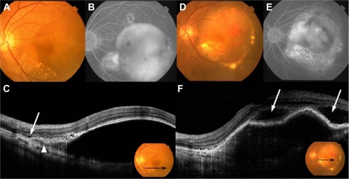 Figure 3 Fundus photography, FA, ICGA, and OCT performed in patient 7.