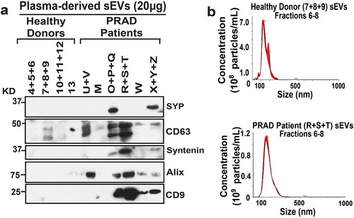 Figure 4. PRAD patient plasma-derived sEVs are enriched in SYP and sEV classical markers. (a) Immunoblotting (IB) analysis of pooled plasma sEV fractions (Fractions 6–8) from healthy donor (4–13) or PRAD patients (M-Z); 20 μg of protein were loaded per sEV sample. Expression of synaptophysin (SYP), CD63, Syntenin, Alix, and CD9 was analyzed. (b) Nanoparticle tracking analysis (NTA) of size and concentration of pooled sEVs (Fractions 6–8) from healthy donor plasma (7 + 8 + 9) or PRAD patient plasma (R+S+T).