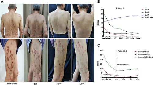 Figure 1 Clinical lesions of patient 1 and assessment index changes of all patients. (A) Lesion changes in patient 1 at baseline and at weeks 4, 16, and 20 of dupilumab injection. (B) Development in NRS, DLQI, ACT, and IGA-CPG scores in patient 1. (C) A mean score change in the NRS, DLQI, and IGA-CPG for patient 2–4.