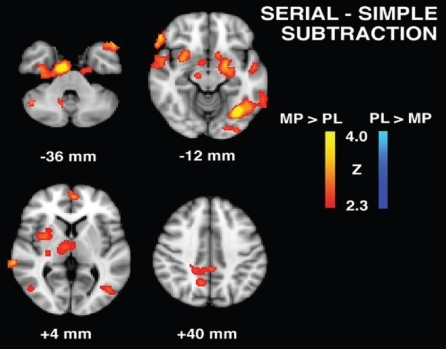 Figure 2 Serial subtraction task group contrast maps for methylphenidate (MP) and placebo (PL) conditions patients with post-stroke depression.