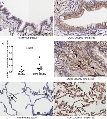 Figure 1 Expression of the activated MEK pathway evidenced through ERK 1/2 phosphorylation in COPD. (A–B) Increased activation of the pathway was observed in lung tissue from patients with end-stage COPD (GOLD 4) in comparison to healthy lung tissue. (C) Quantification of staining pattern in bronchial epithelia showed a significant increase (*p 0.0293 Mann–Whitney test) in pERK1/2 in severe COPD. (D) pERK1/2 staining was also observed in areas of remodeling in GOLD4 (black arrows) and (F) in alveolar macrophages in GOLD4 but not in (E) healthy lung tissue. Sections shown are representative.