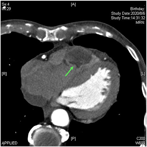 Figure 2 Chest computed tomography performed on August 6, 2020, showing a new lesion in the right ventricle near the pulmonary valve.