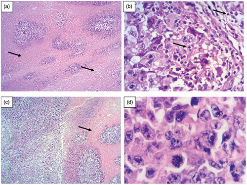 Figure 10. (a) Histological analyses revealed an extensive necrotic area in the deep dermis of mice paw of the untreated group after 18 days of the experiment (arrow, HE, 100×). (b) Inflammatory cells accumulated on the tumor site of mice paw of the untreated group (arrow, HE, 400×). (c) Smaller necrotic area was observed in mice paw of the treated group (receiving MTX PCL implants) after 18 days of the experiment (arrow, HE, 100×). (d) Tumor cells from both groups presented similar characteristics: pleomorphism and anaplasty, with diminished cytoplasm and frequent mitosis events. (HE 100×).