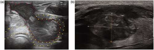 Figure 1. US images of SAN with or without nodule rupture. (a) SAN with nodule rupture, the continuity of thyroid capsular is interrupted and the necrotic contents of the ablated lesion (areas marked by red dots) oozed out of the thyroid (areas marked by yellow dots); (b) SAN without nodule rupture. The shape of ablated lesion was regular and the necrosis was confined in the ablated lesions. SAN: symptomatic aseptic necrosis.