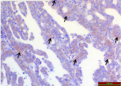 Figure 6 Light microscopic examination of TRPC1 immunoreactivity immunohistochemical staining in Low-Grade colon adenocarcinoma tissues. Arrows indicate areas of immunohistochemical staining.