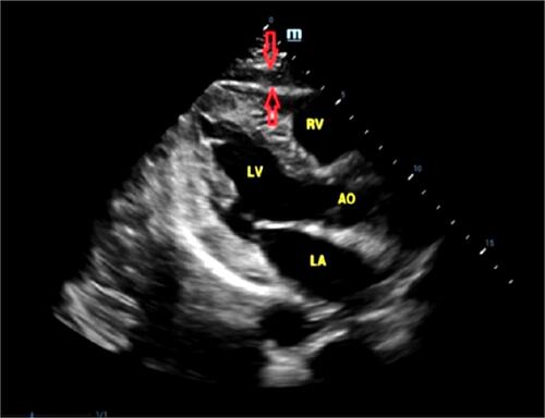 Figure 1 EAT measurement. EAT of the anterior wall of the right ventricle appears as a hypoechoic zone between the epicardium (red arrow below) and pericardium visceral layer (red arrow above).