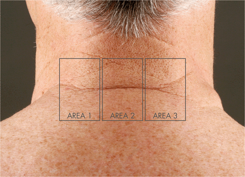 Figure 1. Definition of the treatment areas on the lower necks of all study patients. Area 1 (low energy setting): 50 mJ, 200 MAZ /cm2; Area 2 (medium energy setting): 100 mJ, 150 MAZ/cm2; Area 3 (high energy setting): 300 mJ, 100 MAZ/cm2.