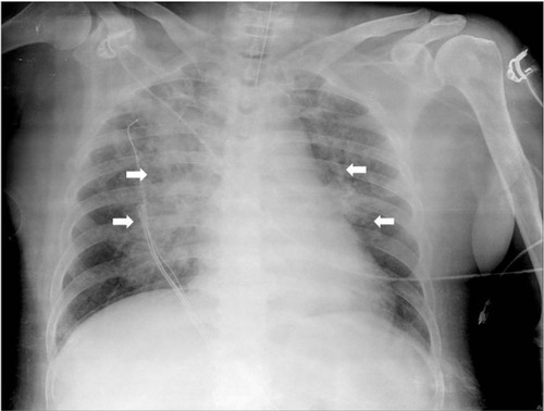 Figure 1 Ten minutes after re-intubation chest X-ray showed diffuse interstitial and alveolar infiltrates in bilateral centralized areas (white arrows).