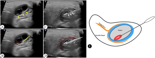 Figure 2. Hydrodissection of parotid tumor under ultrasound guidance. A, B Before TA, injected normal saline or 5% glucose solution around the parotid tumor under the guidance of ultrasound to form a separation zone about 2 mm thick. C, D during TA, continuously injected normal saline or 5% glucose solution to maintain the separation zone. E schematic diagram of hydrodissection. The yellow arrows showing the 22-gauge biopsy needle, the white arrows showing the ablation antenna, and the red dotted lines showing the separation zone.