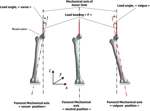 Figure 1. Alignment and boundary conditions applied on the femur model.