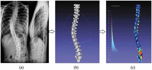 Figure 5. An illustrated view of frontal and lateral radiographs (a) and the 3D model generated (b) analyzed for inter-observer variability in Meshlab (c)