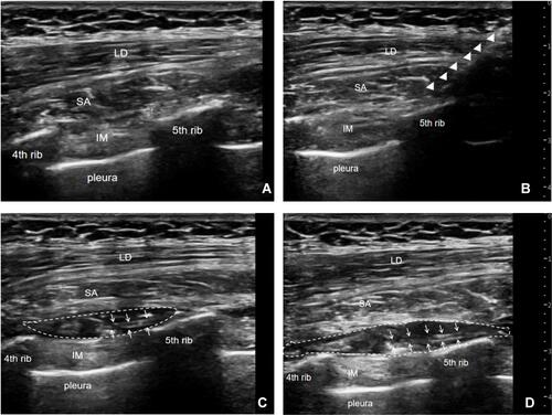 Figure 2 Ultrasound-guided cSAPB with placement of catheter. (A) The serratus anterior was above the 4th and 5th ribs and below the latissimus dorsi. (B) The needle indicated by the triangular arrow passed through the latissimus dorsi and serratus anterior, and arrived at the surface of the 5th rib. (C) The catheter indicated by the arrow was inside the serratus anterior muscle plane, surrounded by the drug solution. (D) Over time, the drug distributed adequately into the fascial plane between the serratus anterior muscle and the external intercostal muscle.Abbreviations: LD, latissimus dorsi; SA, serratus anterior; IM, intercostal muscle.