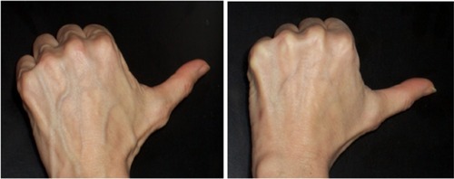 Figure 6 Patient at baseline (left) and Week 12 after receiving three SP-HA injections in the hands (right).