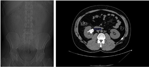 Figure 1 CT scan showing the right staghorn lithiasis.