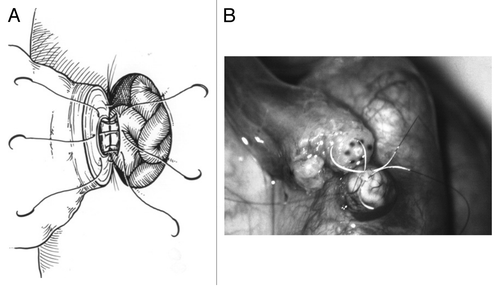 Figure 2. (A) Schematic demonstrating a vasoepididymostomy using a longitudinal intussuscepted technique with 10–0 sutures to intussuscept a longitudinally incised segment of the epididymal tubule into the lumen of the abdominal vasal remnant. The intussusception is then reinforced with multiple 9–0 and 8–0 sutures. (B) Intraoperative vasoepididymostomy using 10–0 sutures.