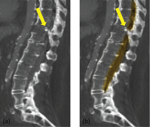 Figure 2. Computed tomography scan of spine showing posterior column involvement in the T10–T11 fracture. (a) Intrusion of the posterior column into the spinal cord canal (arrow). (b) False coloring of the spinal canal highlights the mechanism of compromise of the spinal cord by the posterior column (arrow), with resultant spinal cord damage and neurological deficit.