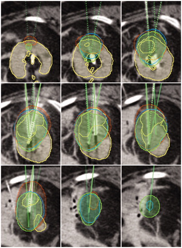 Figure 8. Exemplary kidney case showing the contoured labels (yellow), the simulation result 0 °C isotherm (blue), the contoured ice ball (red), as well as the needles with corresponding ellipsoids (green). Image data sets are courtesy of Dr. Alex King, University Hospital Southampthon.