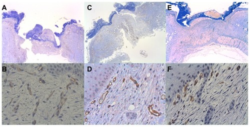 Figure 3 Representative CD34 histological figures of cutaneous wounds 1 week after wounding. At 20×, wound margins are demonstrated (A, C and E). At 400×, note increased numbers of endothelial cells counts in the placebo (about 17) (B) versus bevacizumab (about 11) (D) and ranibizumab (about 12) (F).