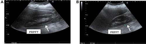 Figure 3 Abdominal ultrasound showing (A) the thickness of the posterior right perinephric fat (PRPFT) is 9.6 mm (posterior to the middle part of the kidney); (B) the thickness from the inner aspect of the anterior abdominal wall to the splenic vein is 37.3 mm.